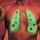 New study to test stem cells’ ability to treat patients with acute lung injury