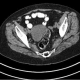 Figure 1: CT scan of the pelvis demonstrating right ovarian cystic mass in a patient with a history of mucinous colorectal carcinoma.