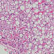 Johns Hopkins performs about 25 liver transplants a year for patients who would not otherwise get the lifesaving surgery. Image shows macrovesicular hepatic steatosis of the liver.