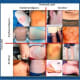 Examples of correct and incorrect visual identifications of the erythema migrans (EM) rash commonly seen in patients with Lyme disease. The images in the top right quadrant actually are EM (true positives). The upper left photos are false negatives, the lower left are false positives and the lower right were correctly ruled out as EM (true negatives). A new AI/deep learning technique from Johns Hopkins Medicine and the Johns Hopkins Applied Research Laboratory greatly increases the chances of correctly identifying EM in photographs.