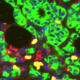 Breast cancers treated with estrogen-depriving therapy were examined using fluorescent markers to highlight cancer cells (green), immune cells (red), cells that are actively dividing (yellow), and DNA, which marks the nucleus of every cell (blue).