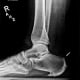 Figure 1: Lateral weight-bearing x-ray of right foot and ankle demonstrating Haglund’s deformity (arrow) of right calcaneus, a source of insertional Achilles tendinitis.