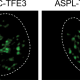 High magnification imaging shows the nuclei of cells from tumors of kidney cancer patients harboring wild-type TFE3 (left) and the three most common TFE3 oncofusions. The oncofusions share an enhanced propensity to form biomolecular condensates, shown in green.