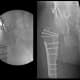 Intra-operative and immediate post-surgical images of a 25-year-old patient demonstrating fixation after periacetabular osteotomy (PAO), surgical hip dislocation, labral repair, femoral head-neck osteochondroplasty, and subtrochanteric derotational femoral osteotomy. Bone grafting was performed at both the acetabular and femoral osteotomy sites.