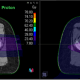 Proton therapy with minimal radiation to surrounding tissues compared to photon therapy