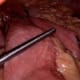 case study gastrointestinal surgery