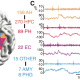 Dr. Bradley Lega and colleagues recorded single-neuron brain activity from memory-relevant regions of the brain while patients were given lists of words and asked to recall as many as they could. The researchers found that specific neurons fire together in a consistent order when a person learns information to be recalled later, but less frequently and out of order when information is forgotten.