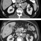 In one-quarter of the men, tumors shrank partially or completely with the combined immunotherapy. Here’s an example from one man. Look at the mass marked with the X in the image on the top. Below is the same man, 24 weeks later. See how the cancer has shrunk. “These responses were durable and typically lasted more than nine months,” says Antonarakis.