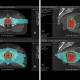 Figure 3a, left: Proton
(top panels) vs IMRT plan (bottom panels) for favorable intermediate risk prostate cancer.