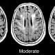 Brain scans showing white matter damage.