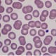 The latest research from Cedars-Sinai Guerin Children’s investigators has advanced our understanding of the role that blood platelets (shown here in dark purple) play in Kawasaki disease. Photo by Getty.