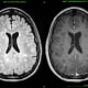 T2 hyperintensities and gadolinium-enhancing lesions in the supra- and infratentorial regions of the brain.