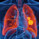 UT Southwestern researchers have identified a possible way to enhance the response to radiotherapy when treating lung cancer, shown in this illustration. (Photo credit: Getty Images)