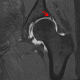 Coronal MR image shows an anterosuperior labral tear.