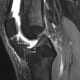 A magnetic resonance image (MRI) of the knee illustrates how the anterior cruciate ligament (ACL) footplate location is determined, with measurements in relation to nearby anatomy landmarks.