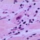 This photomicrograph of a section of myocardial tissue revealed the presence of an intranuclear inclusion body, which was biopsied from a patient with a case of diphtheria-related myocarditis that was caused by the bacterium, Corynebacterium diphtheriae.