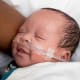 Marcellus Brown had a PDA closure without surgery