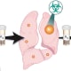 Stereotactic ablative radiation (SAbR) control of isolated progressive metastasis in kidney cancer clinical trial.