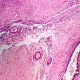 A light micrograph shows an ovarian cyst in pink and purple colors