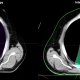 Figure 1: The green colorwash demonstrates the 20 Gy isodose line for a five non-opposed co-planar field IMRT plan (left) compared to a two field IMPT plan (right) that were both prescribed to 50.4 Gy. It is obvious that the mean heart dose is substantially less, but in this case the maximum dose to the aortic valve prior to a planned replacement is less than four Gy.