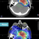 Far above: Radiation coverage with proton therapy; no exit dose. Above: Radiation coverage with photon therapy; exit dose exists