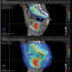 Radiation cov Figure 1a. Dose color wash comparison of intensity modulated proton (top panels) vs photon (bottom panels) radiation therapy (IMPT vs IMRT).