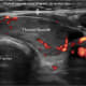 An ultrasound picture of the thyroid nodule, seen as an oval grey mass, sitting on top of the trachea (windpipe). It is surrounded by the anterior strap muscles, sternocleidomastoid muscle and common carotid artery.