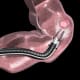 Controlled resection of superficial and deep tumors will make flexible robotic endoscopy an important weapon in Johns Hopkins’ fight against colon cancer. Image shows rendering of robotic endoscopic resection.