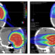 case study for proton therapy