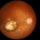 Could a New lntraocular Treatment Platform Offer Hope for Patients with Wet Age-Related Macular Degeneration?