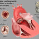 Age is a common culprit when aortic valve stenosis occurs.