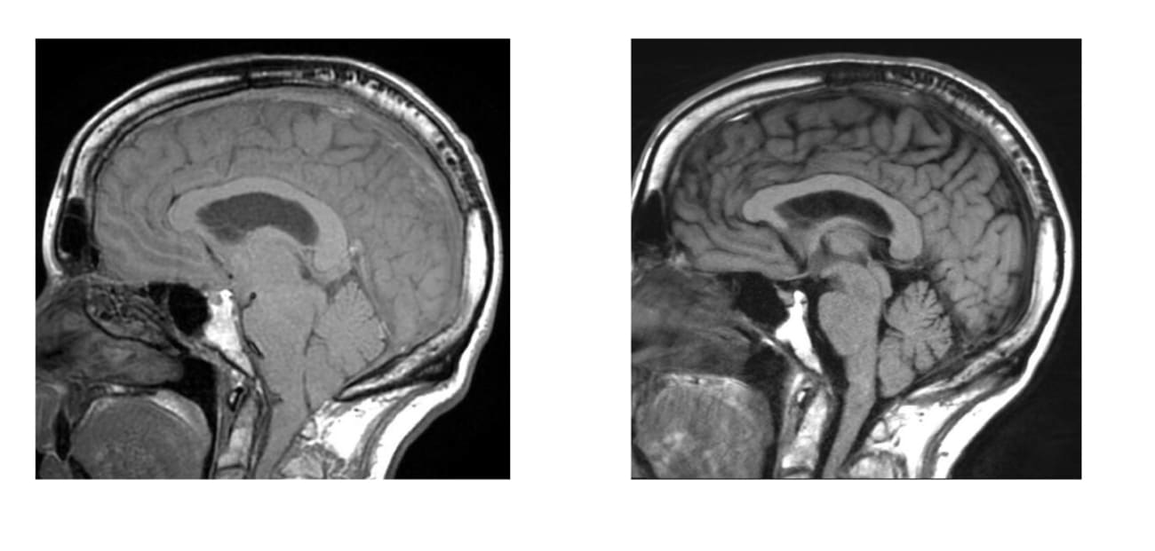 On the Left: An image of brain sagging. On the right: Post-op resolution of brain sagging