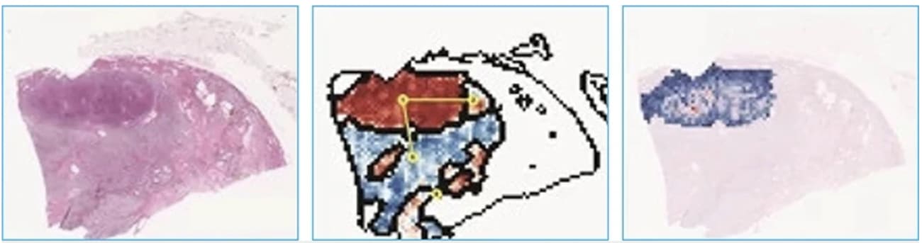 AI models process images of pathology slides and highlight areas of interest related to cancer and the immune system’s effort to defeat it