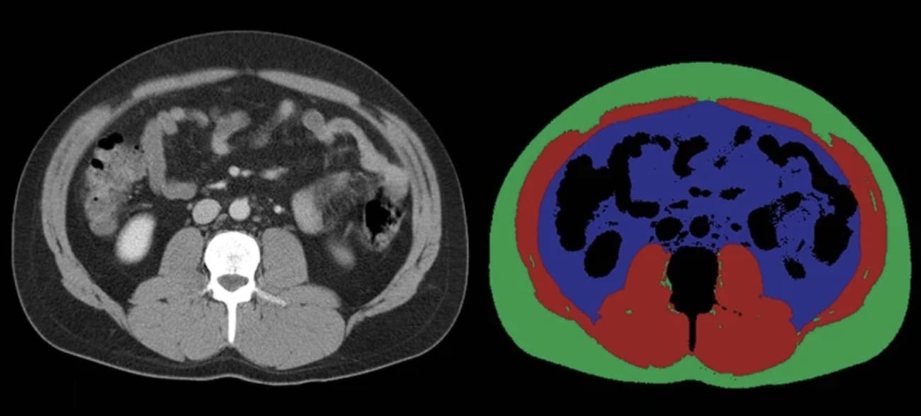 AI technology is analyzing CT scans like those pictured here to detect loss of muscle mass, which may be a warning sign of pancreatic cancer.