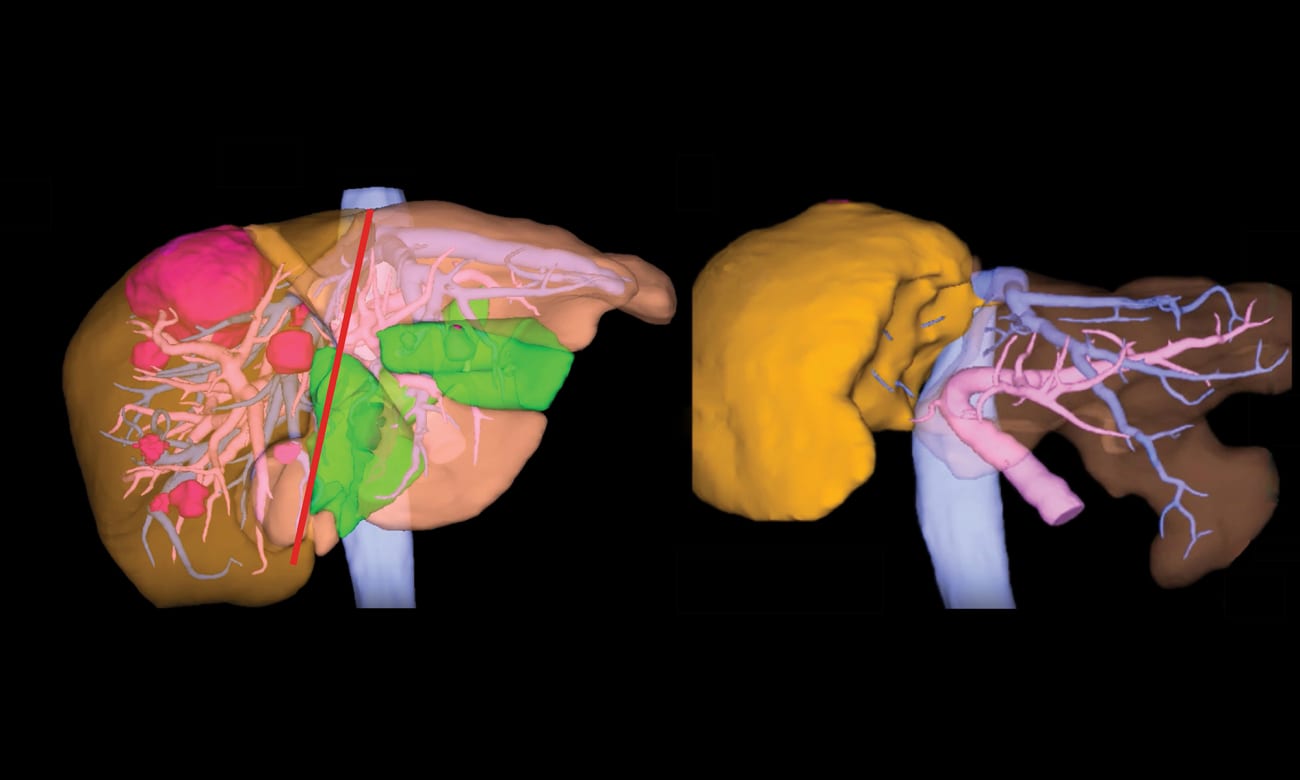 A 3D image shows before and after renderings of the liver of a patient undergoing an ALPPS operation.