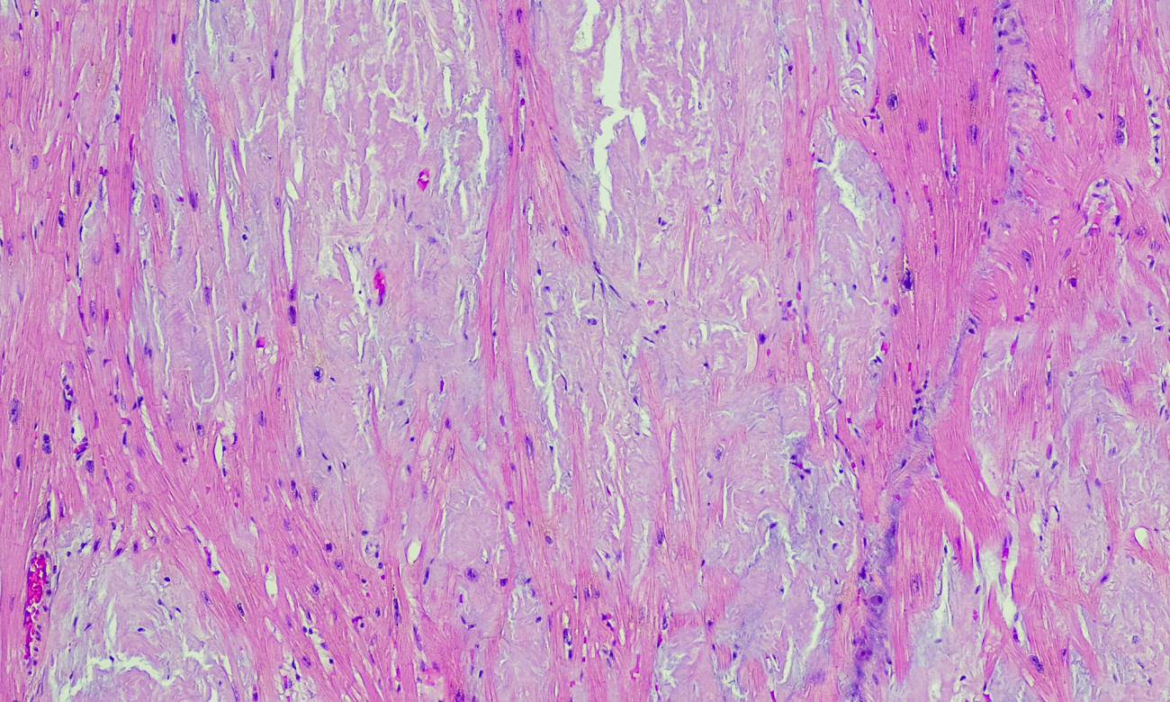 This heart biopsy image shows the faulty protein buildup stained as pink.