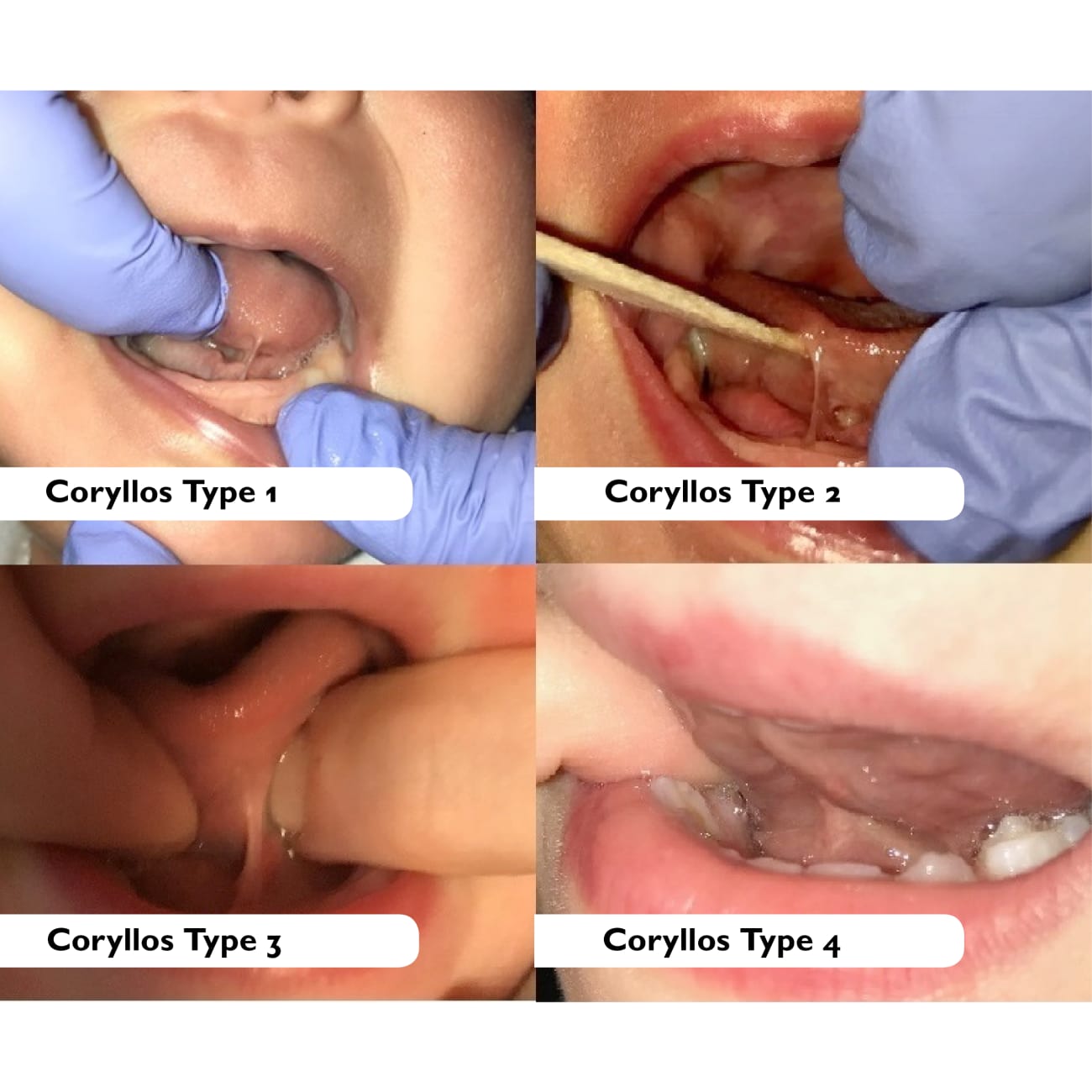 ANKYLOGLOSSIA_MOUTHS