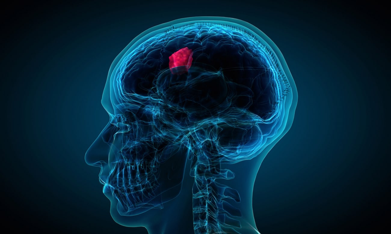 an illustration shows a blue ultrasound-like image of the head and neck, with a brain tumor glowing pink