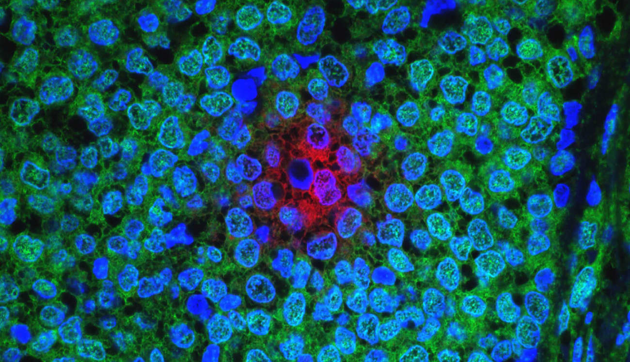 breast-cancer-cells
