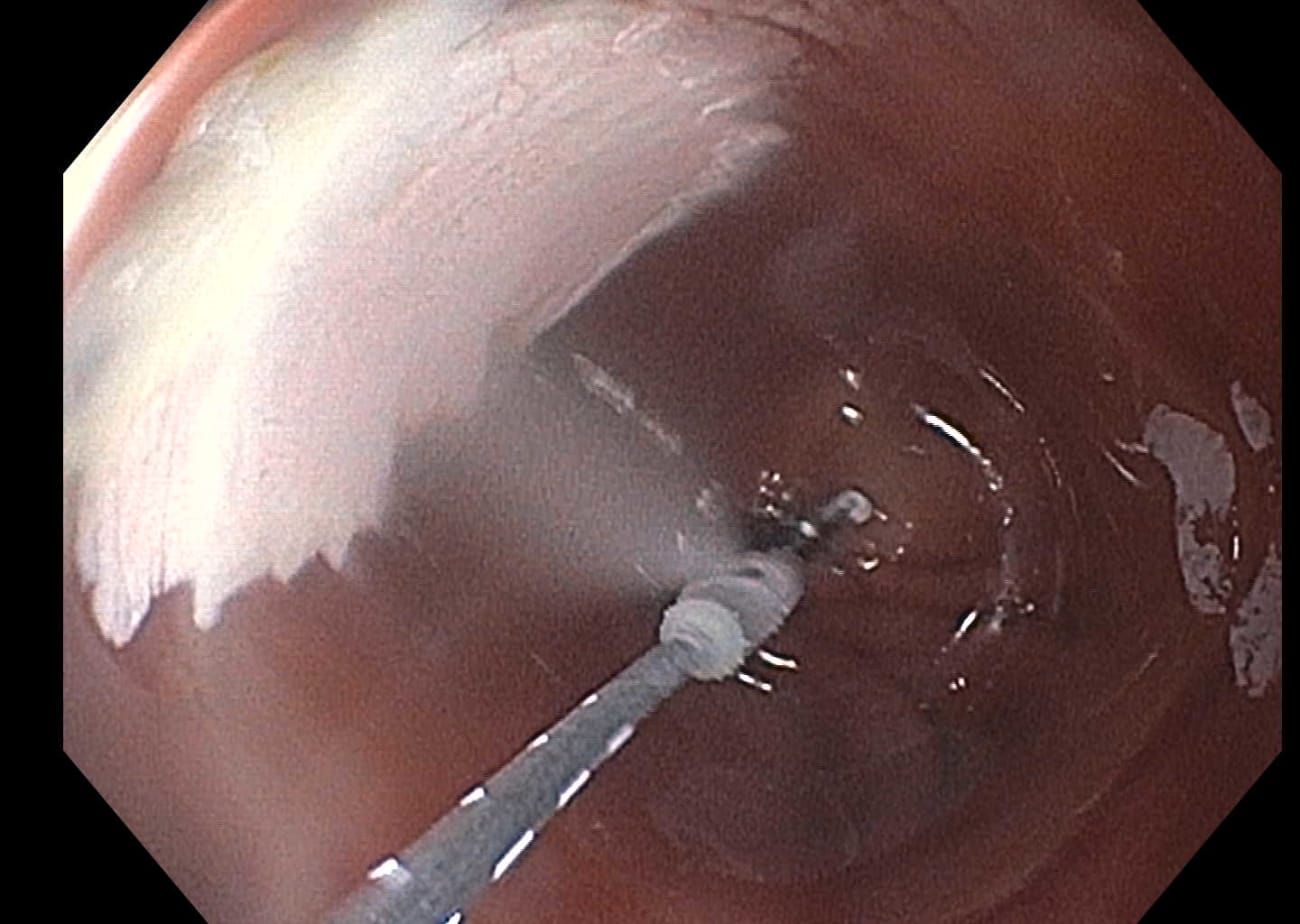 endoscopic ablation of irregular cells