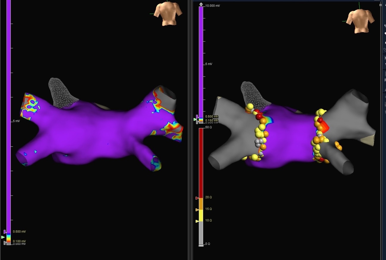 cardiac ablation