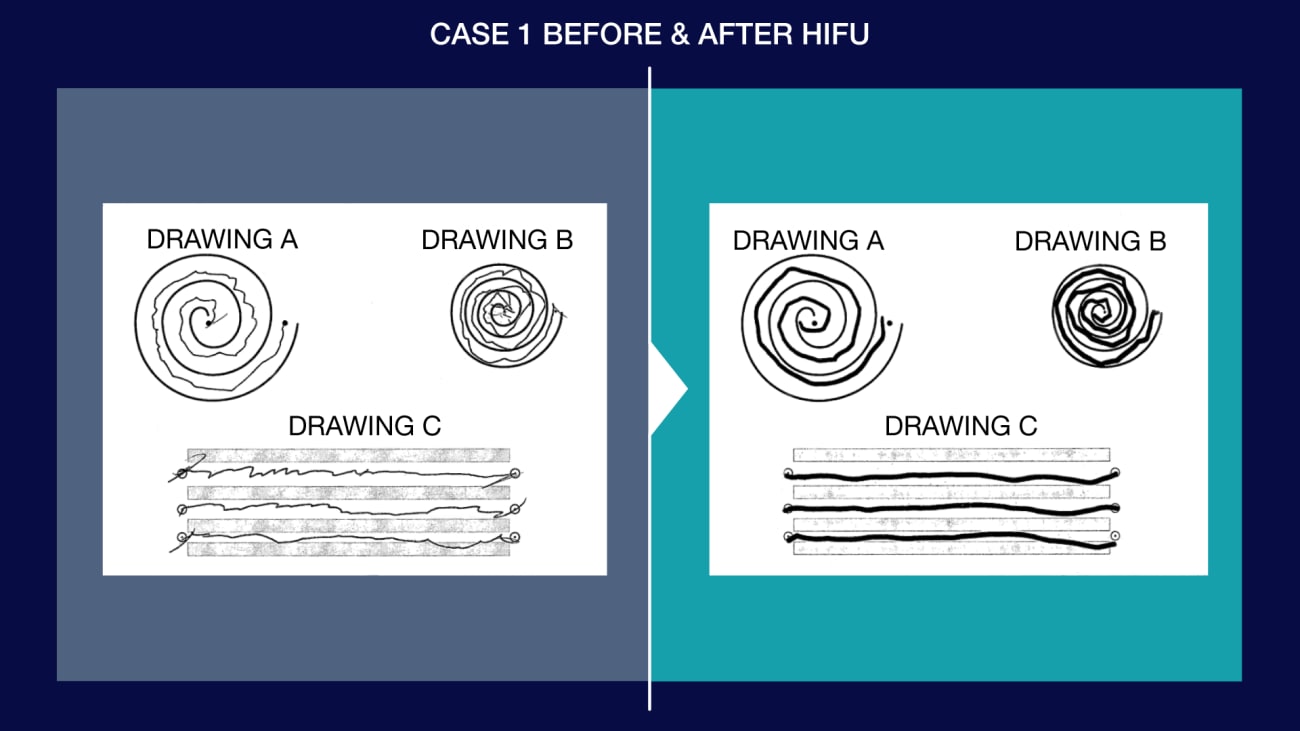 case-1-before-and-after-hifu-1920x1080