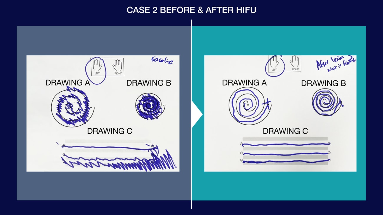 case-2-before-and-after-hifu-1920x1080