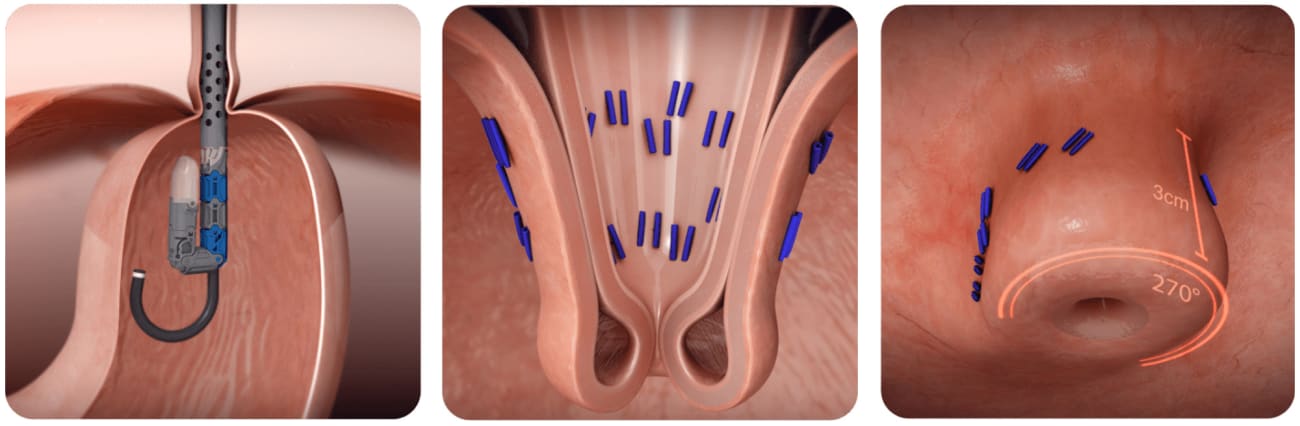 Three images show the steps of a cTIF surgery.