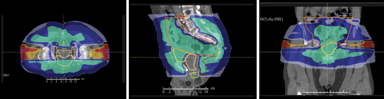 excess radiation dose