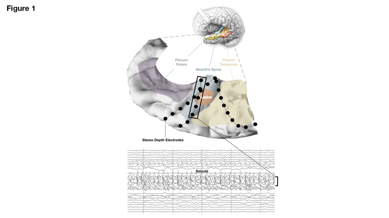 A segment of a single seizure is shown with ictal activity confined to left Heschl’s gyrus. Lateral temporal and frontoparietal grids are not shown but were implanted for comprehensive language mapping and seizure localization.