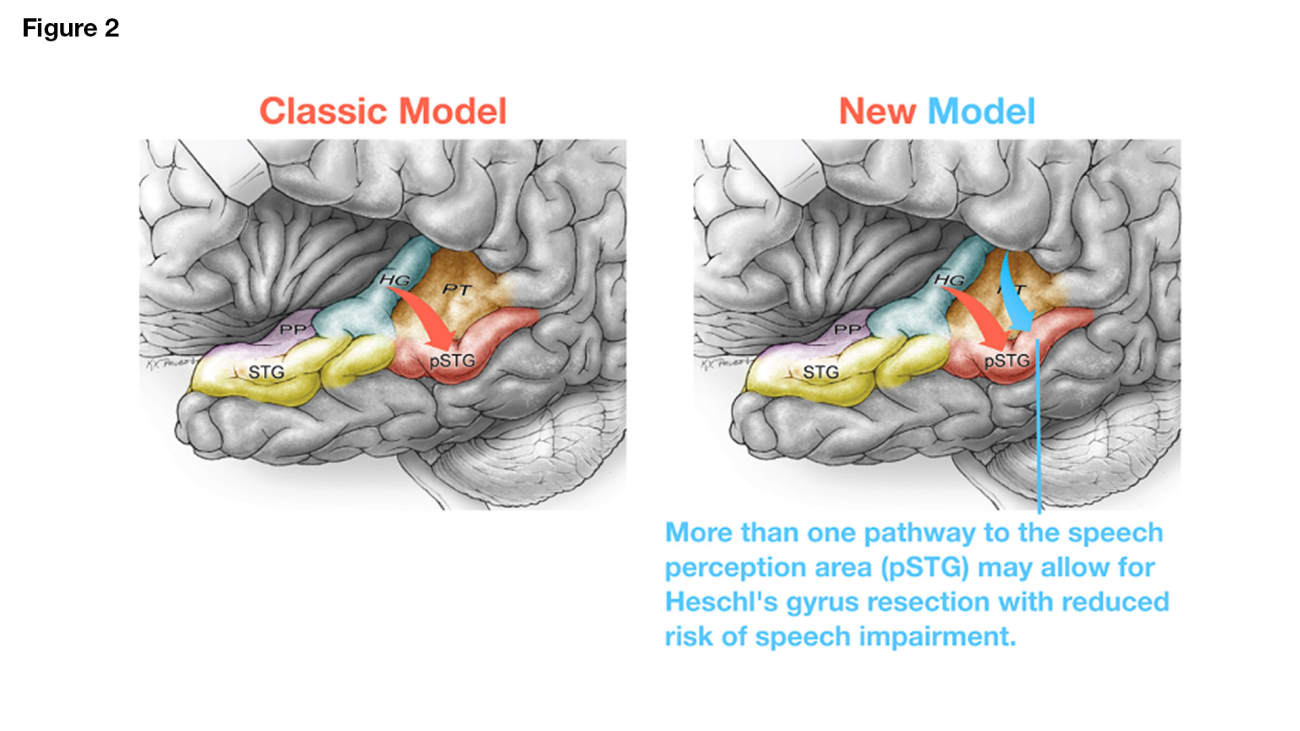 More than one pathway to the speech perception area (pSTG) may allow for Heschl's gyrus resection with reduced risk of speech impairment.