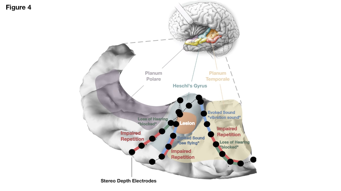 Additional lateral temporal cortex mapping (not shown) confirmed the presence of Wernicke’s area in the left pSTG