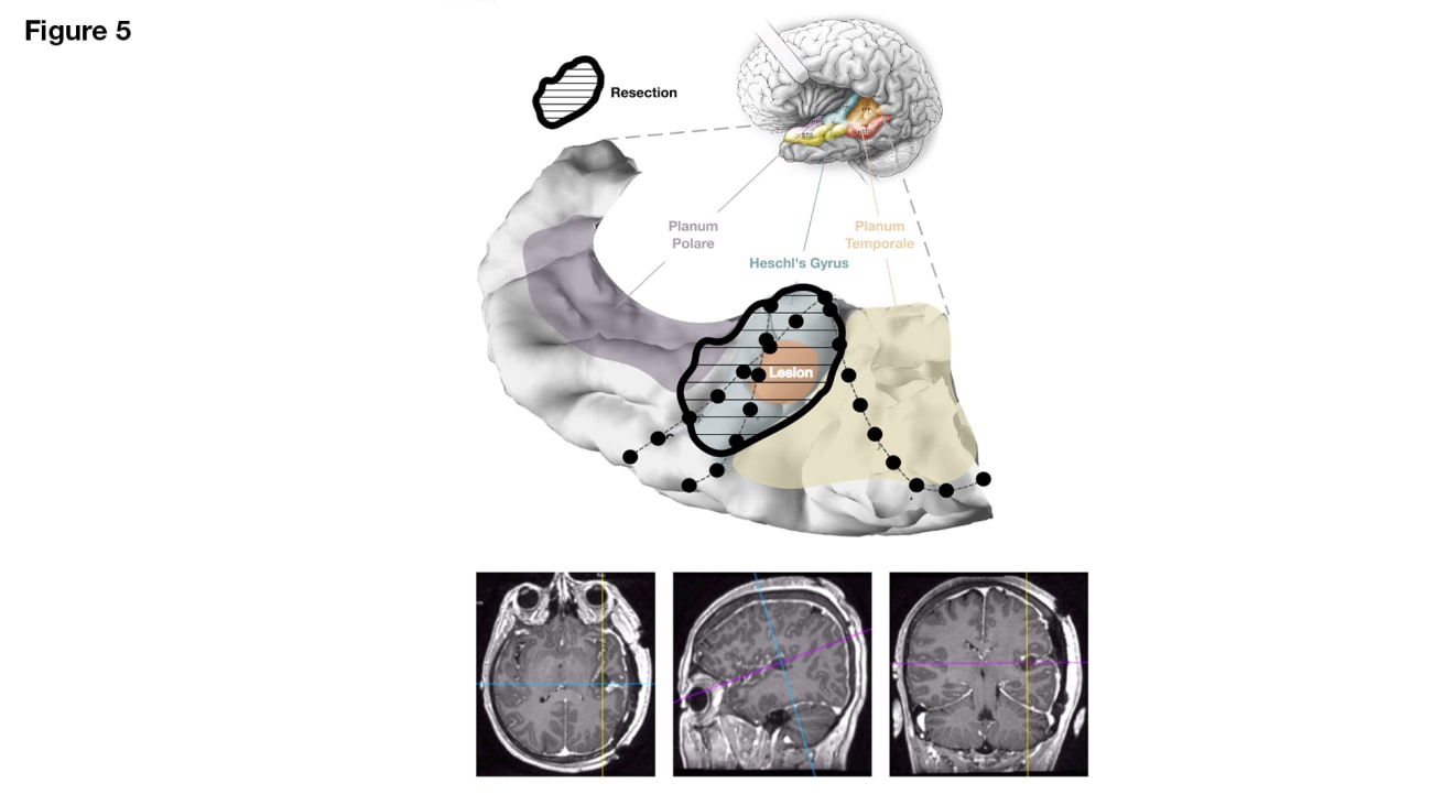 Postoperative MRI and reconstruction showing the resection margins with full removal of the lesion and Heschl’s gyrus. 