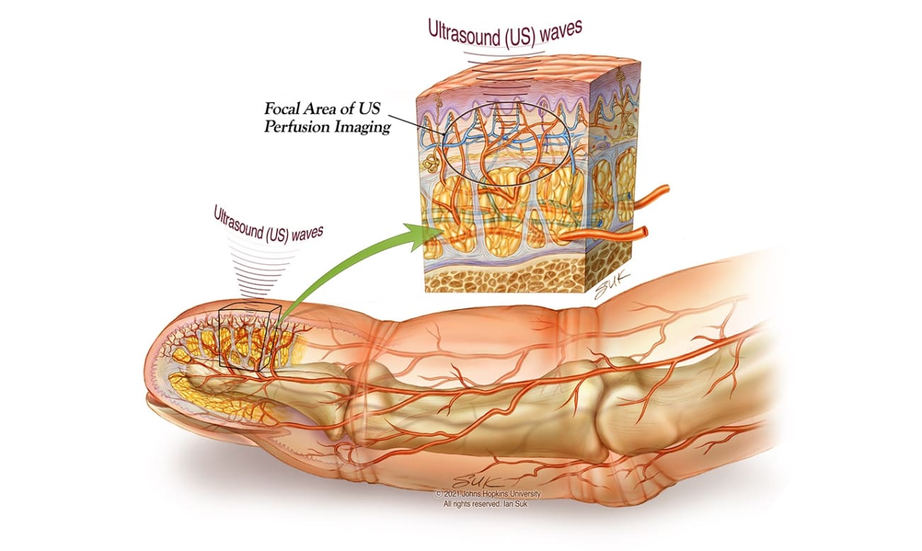 A medical illustration shows the circulatory system inside of a finger, which is used as a model for the small vessels in the spinal cord